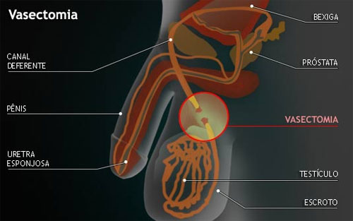 Gravidez ap�s a vasectomia